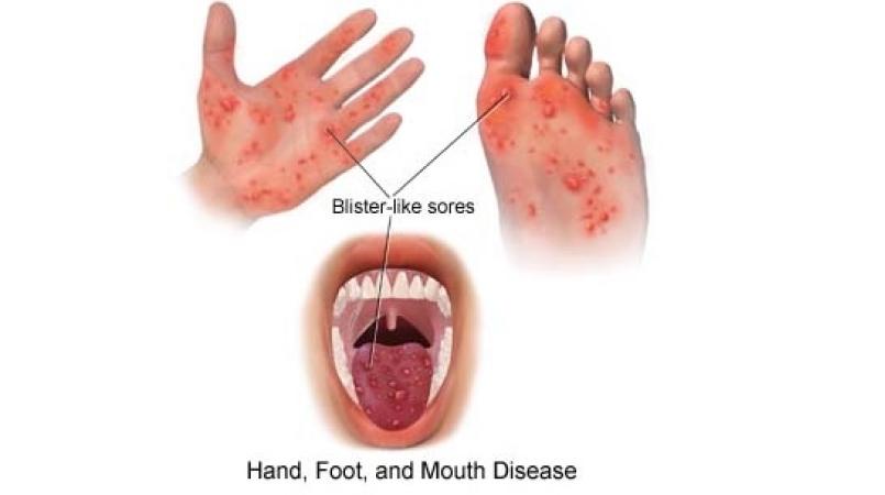 Hand, foot and mouth disease - NHS