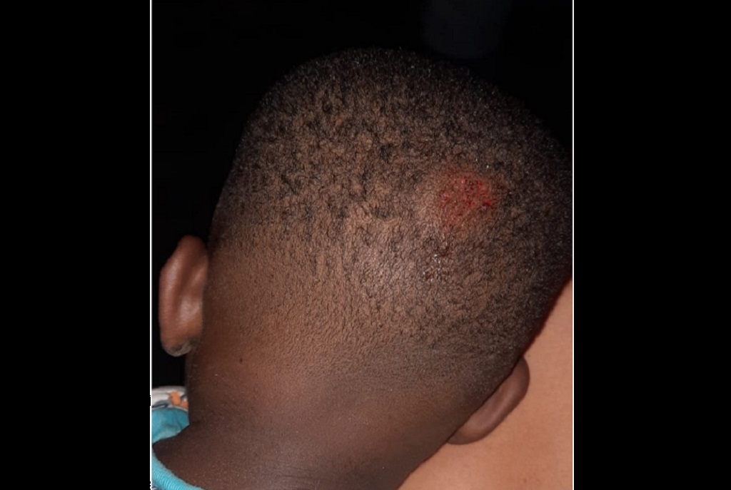 Sint Maarten Toddler Injured In Scooter Accident Loop Caribbean News