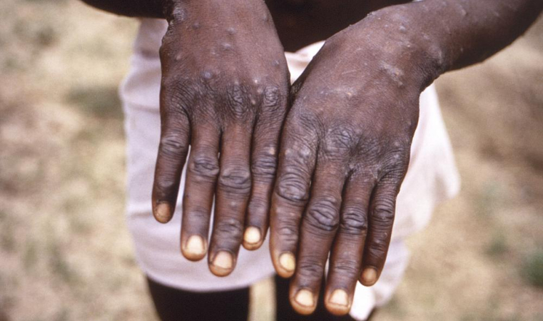 Watch Ministry of Health being vigilant about monkeypox – Latest News