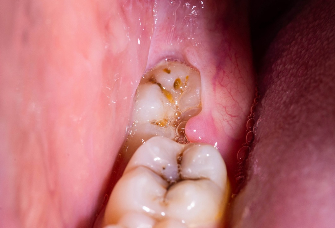 Extraction dentaire et dents de sagesse