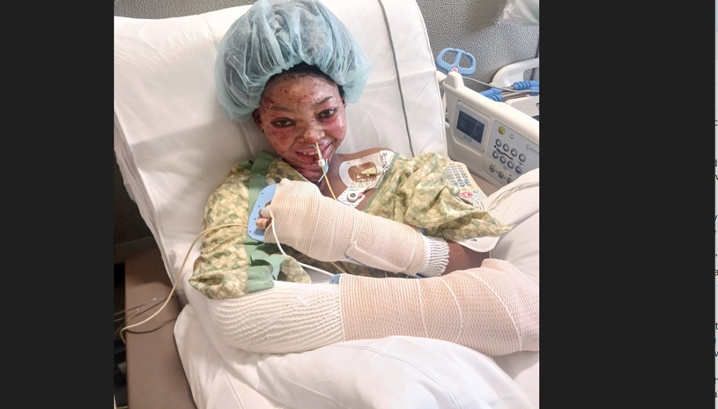 Ackalia Dunkley, the 14-year-old girl from St Elizabeth High School was injured in a gas explosion at her home on June 16.