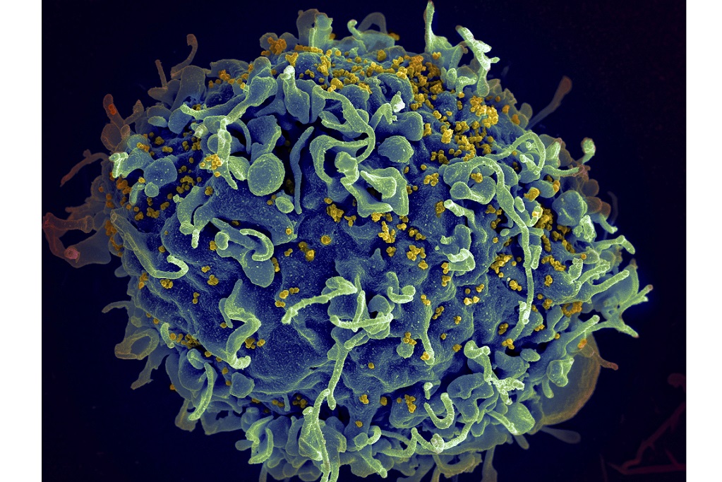 FILE - This electron microscope image made available by the US National Institutes of Health shows a human T cell, in blue, under attack by HIV, in yellow, the virus that causes AIDS. (Seth Pincus, Elizabeth Fischer, Austin Athman/National Institute of Allergy and Infectious Diseases/NIH via AP, File)